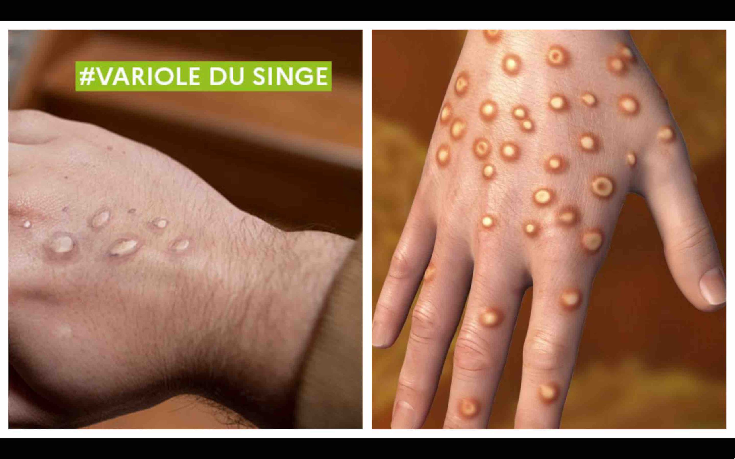 variole simienne du singe Mpox Maroc Monkeypox Morocco